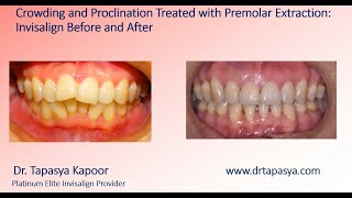 Crowding and Proclination Treated with Premolar Extraction Invisalign Before and After [upl. by Htebaras]