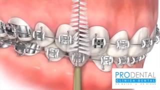 ¿Cómo lavarse correctamente los dientes con brackets [upl. by Ecilahs]