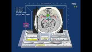 Virtual Reality planning of skull base surgery Tuberculum sellae meningioma [upl. by Castro]