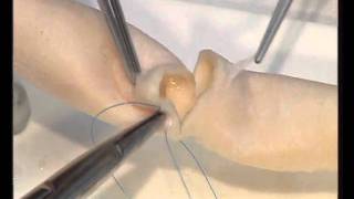 Transverse Aortotomy and double layer closure CABG Cardiac Surgery [upl. by Lebiralc]