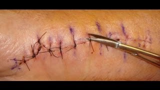 Suture Removal Protocol [upl. by Livvy235]