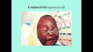 Conjunctivitis  CRASH Medical Review Series [upl. by Gabrila]