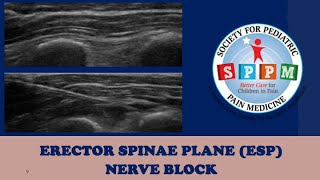 Erector Spinae Plane ESP Nerve Block [upl. by Aduh726]