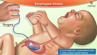 Esophageal Atresia  Etiology Types Pathophysiology  Clinical Features  Diagnosis and Treatment [upl. by Nuahsar]