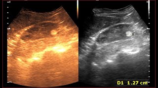 Angiomyolipoma kidney  Benign Renal Masses  Kidney Tumor [upl. by Balac]