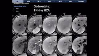 CT Differential Diagnosis of Focal Hepatic Lesions Basic Radiology [upl. by Batista248]