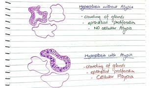 Endometrial Hyperplasia  Pathology [upl. by Stranger459]