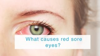 What causes red sore eyes [upl. by Aikenat419]