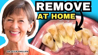 Tartar Removal At Home and How To Prevent Tartar [upl. by Fernas470]