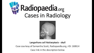 Langerhans cell histiocytosis  skull Radiopaediaorg Cases in Radiology [upl. by Aneri]