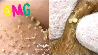 Ultimate Satisfying Pimple Popping Compilation 2024  Best Blackhead amp Acne Removal Videos [upl. by Codi294]