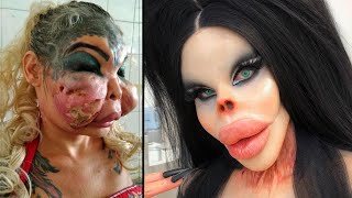 When Plastic Surgery Goes Horribly Wrong [upl. by Yalc]