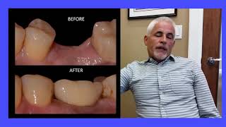 BEFORE amp AFTER DENTAL IMPLANT Missing Lower Molar  Milton Oakville Burlington Mississauga [upl. by Gordie]