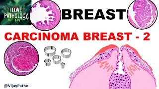 Diseases of Breast Part 5 Breast carcinoma DCIS LCIS amp Pagets Disease of Nipple [upl. by Caruso]