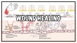 Wound Healing  Stages of healing and pathology [upl. by Missak]