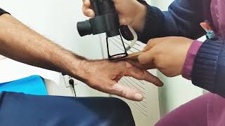 New Treatment for vitiligo 2024  Fractional Laser vitiligo laser [upl. by Chaunce]