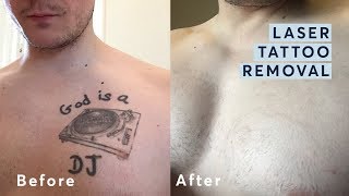 Laser Tattoo Removal  Before and After through all the stages [upl. by Uv972]