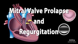 Mitral Valve Prolapse and Regurgitation Animation [upl. by Genesia850]