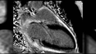 Cardiac MRI Cases on radRoundscom Radiology Network [upl. by Donalt427]