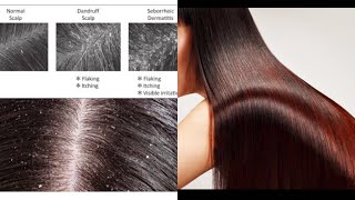 DANDRUFF SEBORRHEIC DERMATITIS amp HAIR STRAIGHTENINGinfection PREVENTION EXPLAINEDNidhi Chaudhary [upl. by Noryk]