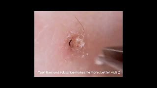 Tweezist Plucking ingrown hair compilation 2 [upl. by Leann705]