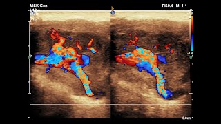 Pleomorphic Adenoma of Parotid Gland  Ultrasound  Doppler  Case 05 [upl. by Ahsit]