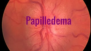 Papilledema A Swollen optic disc [upl. by Latsyrhc]