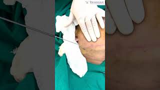 Chin Liposuction Surgery Live Procedure  The Aesculpir Clinic Delhi [upl. by Irahs]