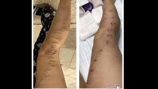 VARICOSE VEIN REMOVAL 1 DAY AFTER PROCEDURE 22323  Angies Life [upl. by Tice]