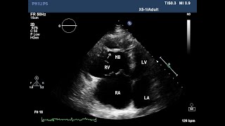 Typical Appearance for arrhythmogenic right ventricular dysplasiacardiomyopathyARVDARVC [upl. by Riesman]