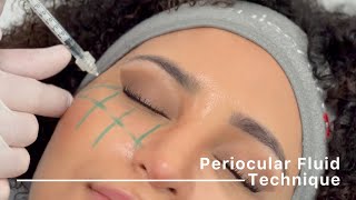 Periocular Fluid Technique injection protocol by Dr Siquier amp Dr Taskesen [upl. by Eizle]