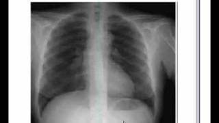 Respiratory system X ray Chest Pneumonia [upl. by Link]