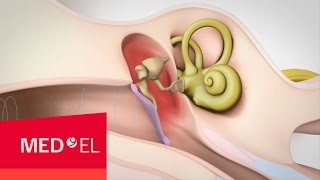 Conductive Hearing Loss Explained  MEDEL [upl. by Hymen]