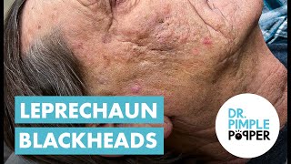 Blackhead Blackheads amp Blackheads Extended Leprechaun Blackheads [upl. by Abihsot463]