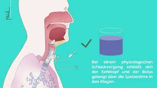 Subglottische Absaugung einer Trachealkanüle  Animation  Andreas Fahl MedizintechnikVertrieb GmbH [upl. by Narih]