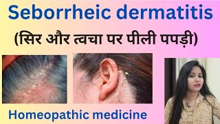 Seborrheic dermatitis treatment सिर और त्वचा पर पीली पपड़ी  Seborrheic dermatitis symptoms amp causes [upl. by Tabor]