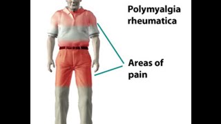 Polymyalgia Rheumatica [upl. by Ecilef]