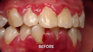 Treatment of Periodontal Gum Disease [upl. by Ykvir]