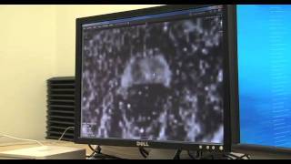 Prostate Biopsy Targeted Biopsy Using MRUltrasound Fusion [upl. by Winston]