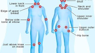 How To Diagnose Fibromyalgia [upl. by Deeas]