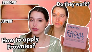 I Tried Frownies Wrinkle Patches For One Week Before and After Testing TikTok [upl. by Aisan]