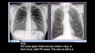 Chest xrays  Smokers Disease COPD  unusual radiographic feature Sabre Sheath Trachea [upl. by Zavras]