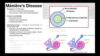 👂 Ménière’s Disease  Presentation Pathophysiology Diagnosis amp Treatment [upl. by Waddle]