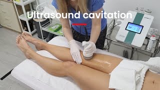 Ultrasound cavitation with radiofrequency and vacuum therapy treatment Manchester UK [upl. by Loftus336]