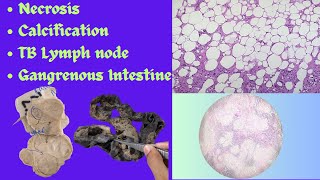 Necrosis Calcification TB lymph nodeGangrenous Intestine identification Pathology practical exam [upl. by Aennaej705]