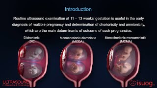 UOG video abstract Outcome of twin pregnancy with two live fetuses at 11–13 weeks’ gestation [upl. by Yasnyl]