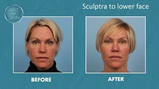 Sculptra volumizing in lower face and marionette lines [upl. by Ahtis]