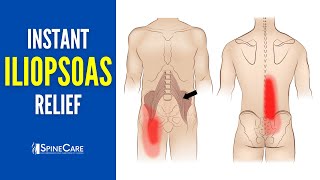 How to Instantly Relieve Iliopsoas Muscle Tightness AND PAIN [upl. by Lleret]