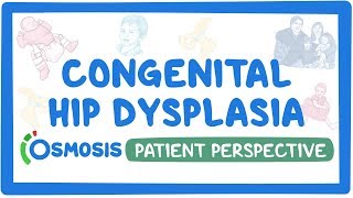 Patient Perspective Congenital hip dysplasia [upl. by Oirobil388]