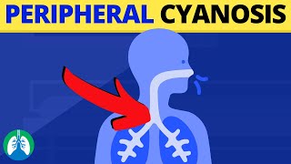 Peripheral Cyanosis Medical Definition  Quick Explainer Video [upl. by Dorweiler420]